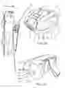 Fig. 02 - Ski and/or board carriage assembly
