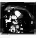 Fig. 06 - Automatic aortic detection and segmentation in three-dimensional image data