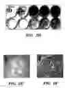 Fig. 06 - Methods of isolation, expansion and differentiation of fetal stem cells from chorionic villus, amniotic fluid, and placenta and therapeutic uses thereof