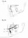 Fig. 04 - Functional orthodontic appliance with an extraoral device