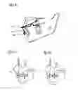 Fig. 05 - Functional orthodontic appliance with an extraoral device