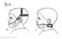 Fig. 06 - Functional orthodontic appliance with an extraoral device