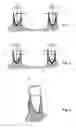 Fig. 02 - Method for correction of the form of dental alveolar arch