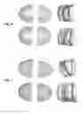 Fig. 04 - Method for correction of the form of dental alveolar arch
