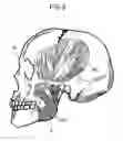 Fig. 07 - Denture base, method of preparing denture bases, and a denture base component