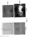 Fig. 30 - Biomarker for determining predisposition and/or prognosis of hepatocellular carcinoma
