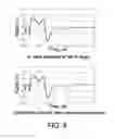 Fig. 09 - Automated stimulus artifact removal for nerve conduction studies