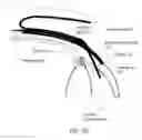 Fig. 10 - Glaucoma Implant Device