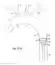 Fig. 16 - Cerebral perfusion augmentation