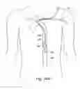 Fig. 17 - Cerebral perfusion augmentation