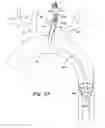 Fig. 19 - Cerebral perfusion augmentation
