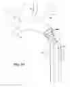 Fig. 20 - Cerebral perfusion augmentation