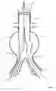 Fig. 03 - Method and apparatus for endovascular graft cutting