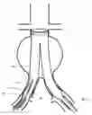 Fig. 07 - Method and apparatus for endovascular graft cutting