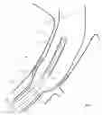 Fig. 08 - Method and apparatus for endovascular graft cutting
