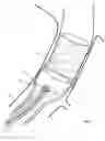 Fig. 13 - Method and apparatus for endovascular graft cutting