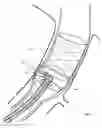 Fig. 14 - Method and apparatus for endovascular graft cutting