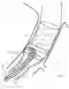 Fig. 15 - Method and apparatus for endovascular graft cutting