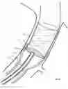 Fig. 17 - Method and apparatus for endovascular graft cutting