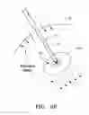 Fig. 08 - Radio frequency lasso