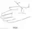 Fig. 07 - Percutaneous scaphoid fixation method and device