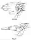 Fig. 08 - Percutaneous scaphoid fixation method and device