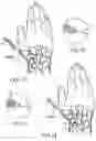Fig. 09 - Percutaneous scaphoid fixation method and device