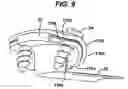 Fig. 09 - Implant fixation methods and apparatus