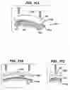 Fig. 11 - Implant fixation methods and apparatus