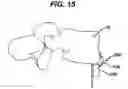 Fig. 15 - Implant fixation methods and apparatus