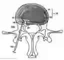 Fig. 01 - Intervertebral disc anulus repair