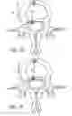 Fig. 04 - Intervertebral disc anulus repair
