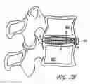 Fig. 10 - Intervertebral disc anulus repair