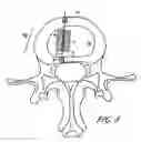 Fig. 11 - Intervertebral disc anulus repair