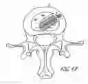 Fig. 12 - Intervertebral disc anulus repair