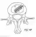 Fig. 13 - Intervertebral disc anulus repair