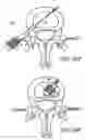 Fig. 14 - Intervertebral disc anulus repair