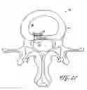 Fig. 15 - Intervertebral disc anulus repair