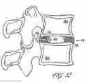 Fig. 16 - Intervertebral disc anulus repair