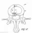 Fig. 17 - Intervertebral disc anulus repair