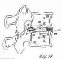 Fig. 18 - Intervertebral disc anulus repair