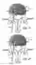 Fig. 22 - Intervertebral disc anulus repair