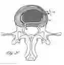 Fig. 27 - Intervertebral disc anulus repair