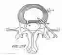 Fig. 30 - Intervertebral disc anulus repair