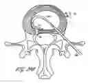 Fig. 31 - Intervertebral disc anulus repair