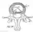 Fig. 32 - Intervertebral disc anulus repair
