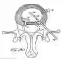 Fig. 33 - Intervertebral disc anulus repair
