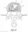 Fig. 79 - Intervertebral disc anulus repair