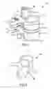Fig. 02 - Surgical Tools and method to facilitate spinal surgery