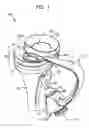 Fig. 02 - Tibial resurfacing system